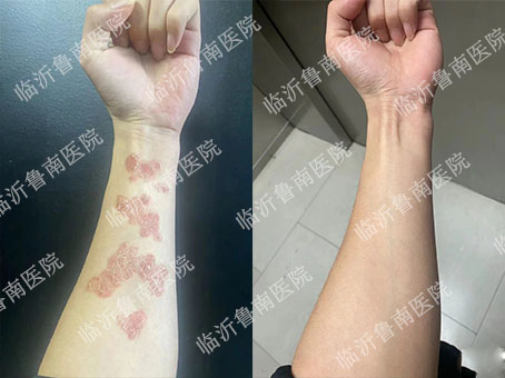 4警惕肢端型白癜风出现这些症状要注意