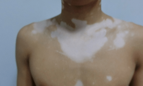 7白癜风到底是什么病一篇文章讲透