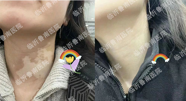 5颈部得了白癜风我们应该怎么办临沂皮肤病医院哪家好