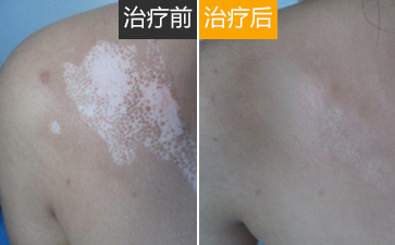 9白癜风患者春天吃这几种瓜助力健康过春季&nbsp;临沂皮肤病医院哪家好