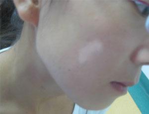 女性白癜风早期有哪些症状表现