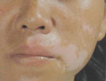 冬季白癜风患者饮食有什么讲究