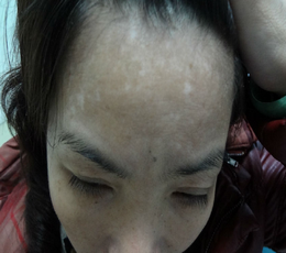 诱发白癜风的因素 