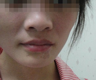 白癜风治愈后又复发能治愈吗 白癜风治愈后又复发能治愈吗