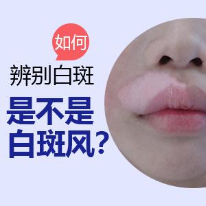女性患白癜风的原因是什么