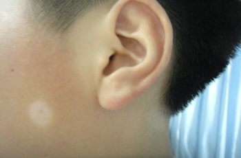 孩子脸上脖子上有白斑是什么